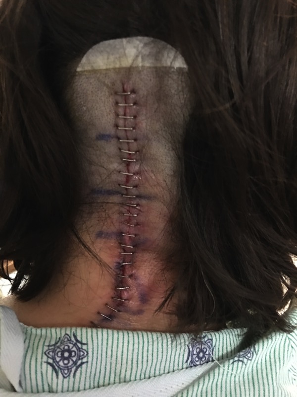 Staples after Chiari Revision Surgery